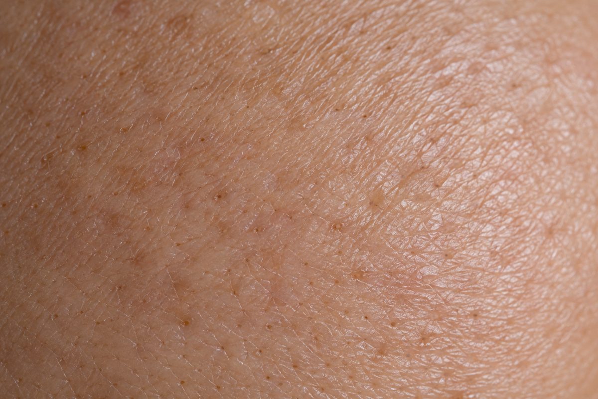 Dermal recovery follow-up showing restored epidermal barrier integrity
